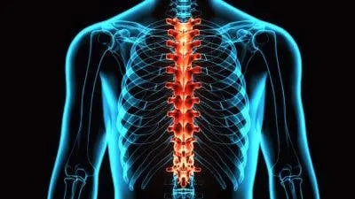 T5 Vertebral Fracture Homeostasis