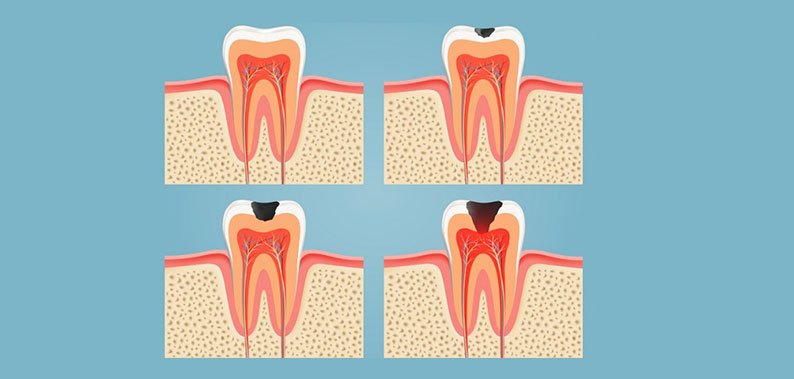 Dental Caries