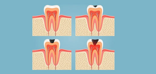 Dental Caries