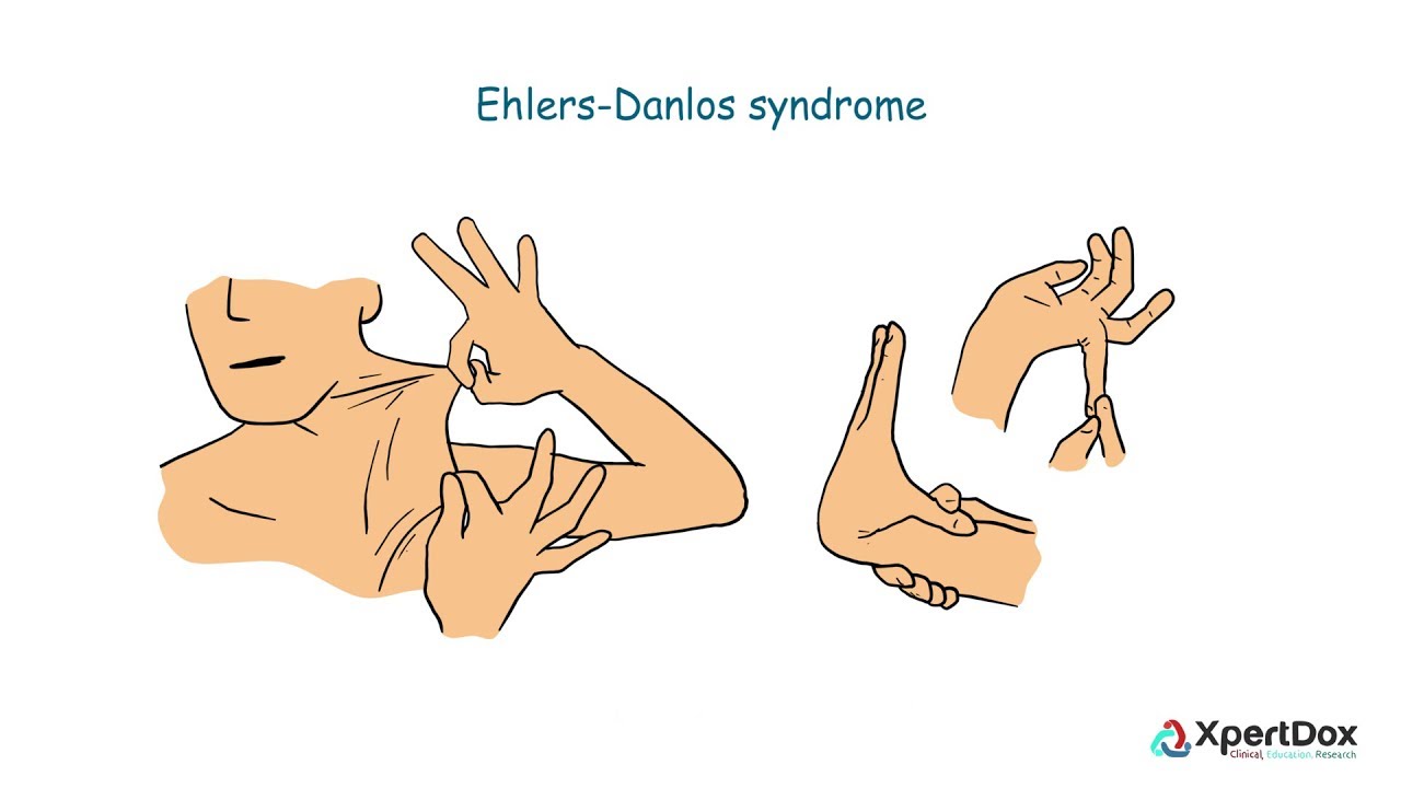 Ehlers-Danlos Syndrome