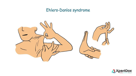 Ehlers-Danlos Syndrome