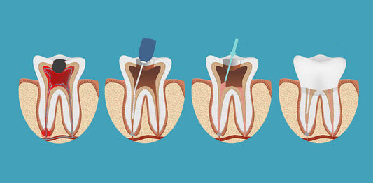 Root Canal